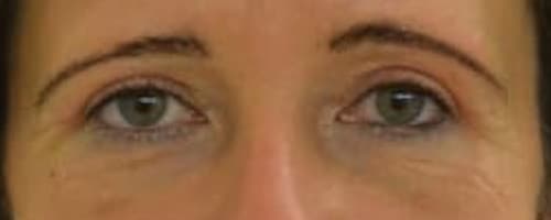 Botox kezelés előtte - utána kép: Botox kezelés előtt