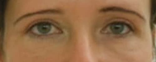Botox kezelés előtte - utána kép: Egy héttel botox injekciós ránctalanító kezelés után