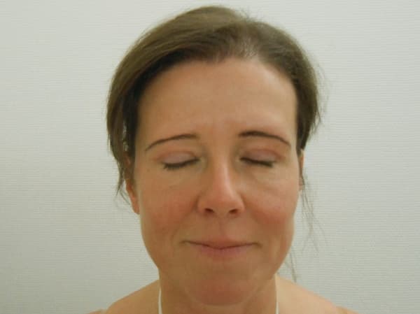 A felső szemhéjplasztika után 3 héttel, a botox injekció után 1 héttel