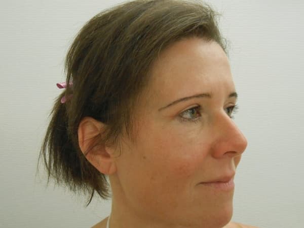 A felső szemhéjplasztika után 3 héttel, a botox injekció után 1 héttel