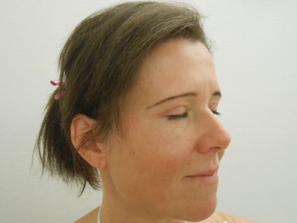 A felső szemhéjplasztika után 3 héttel, a botox injekció után 1 héttel